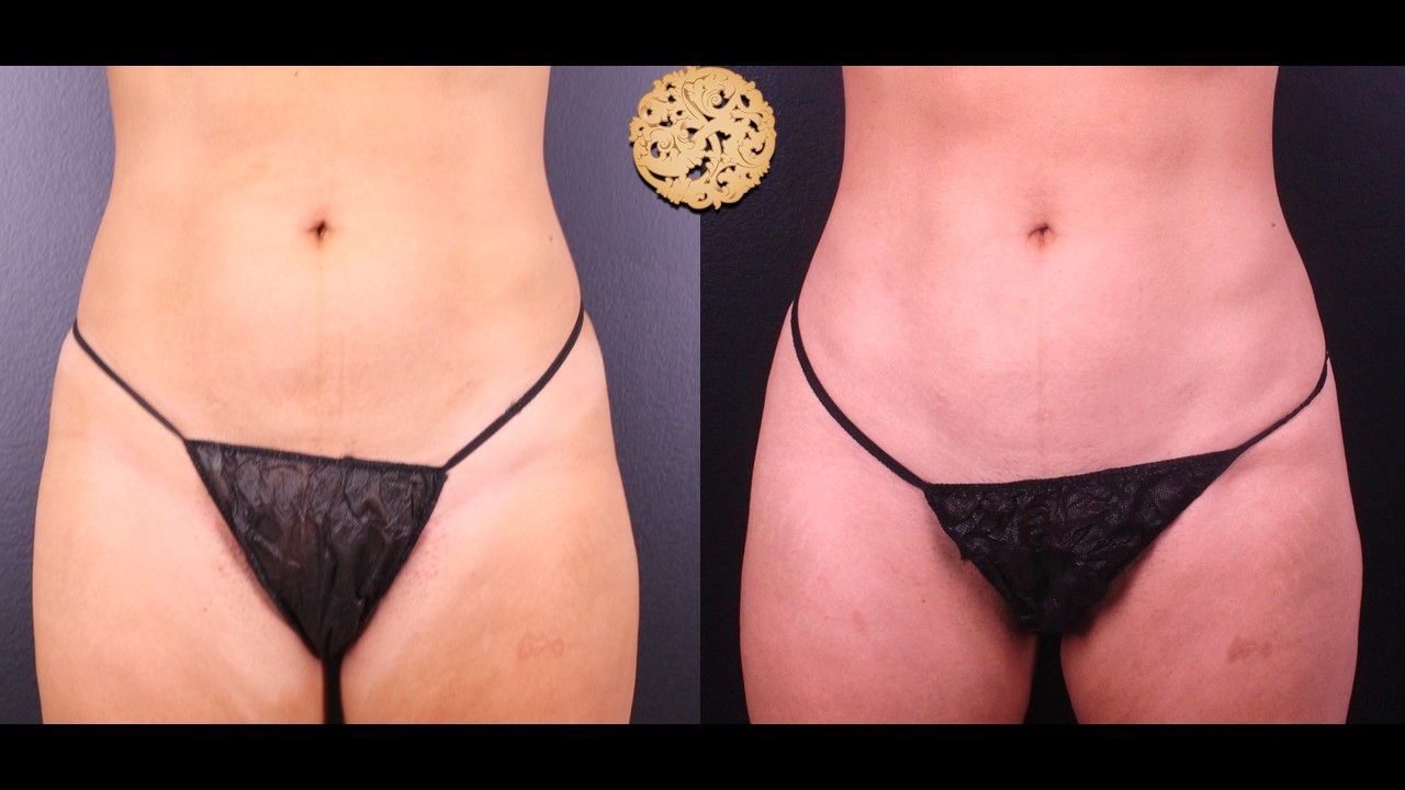 Liposuction Trunk Before & After
