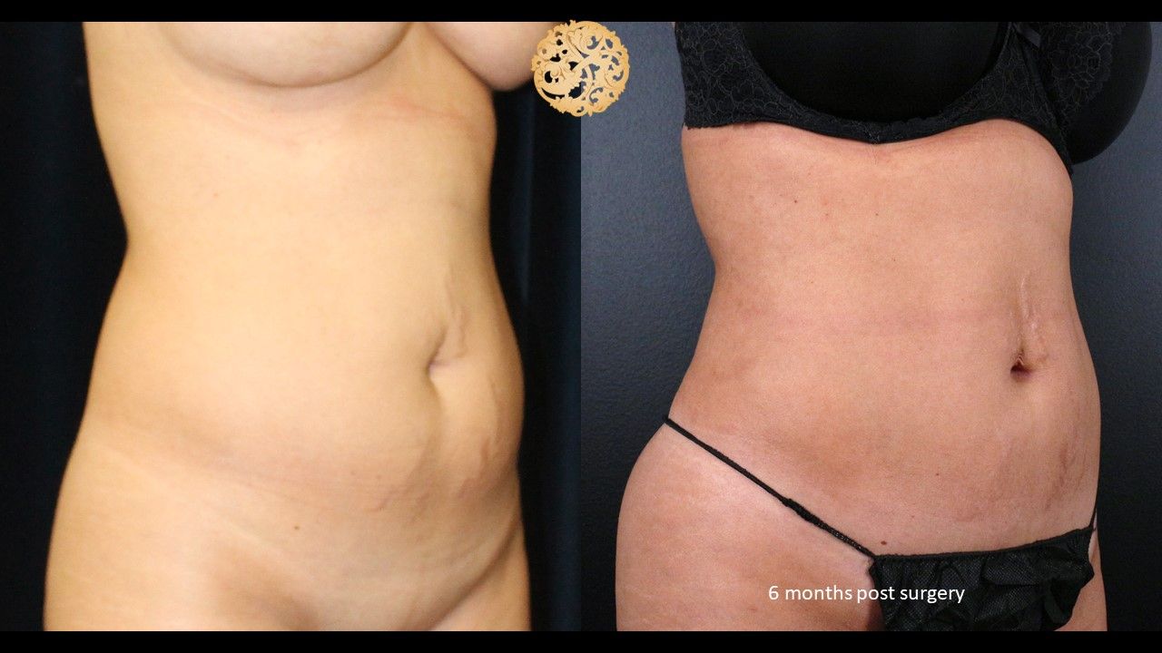 Liposuction Trunk Before & After
