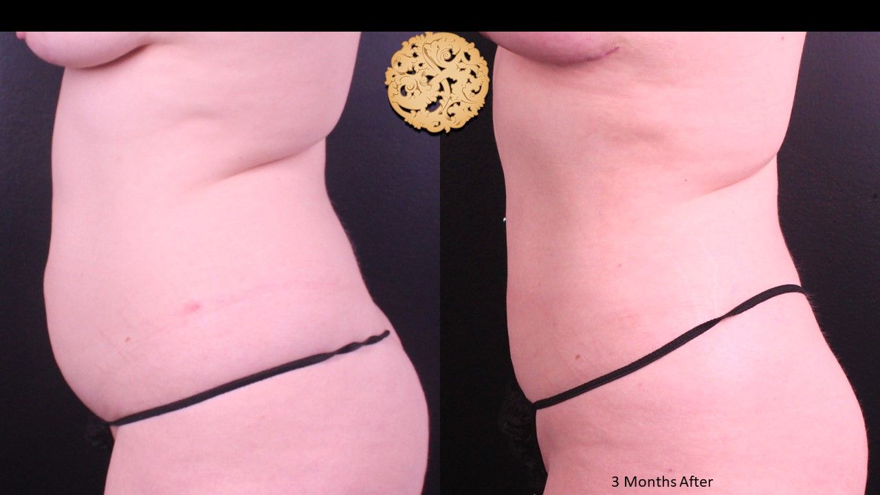 Liposuction Trunk Before & After