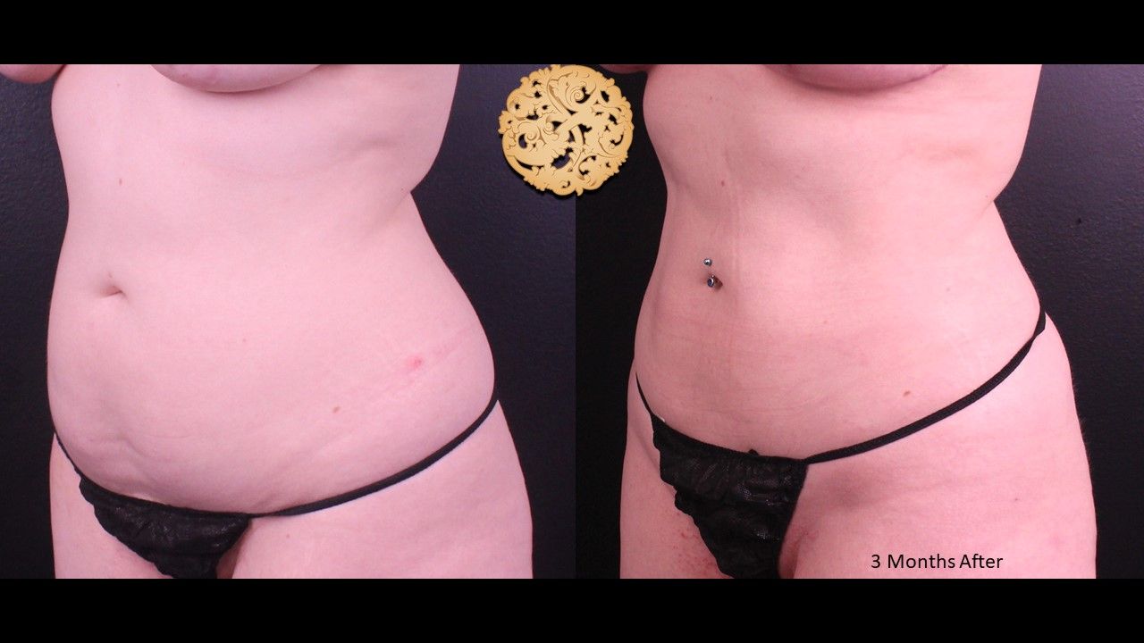 Liposuction Trunk Before & After