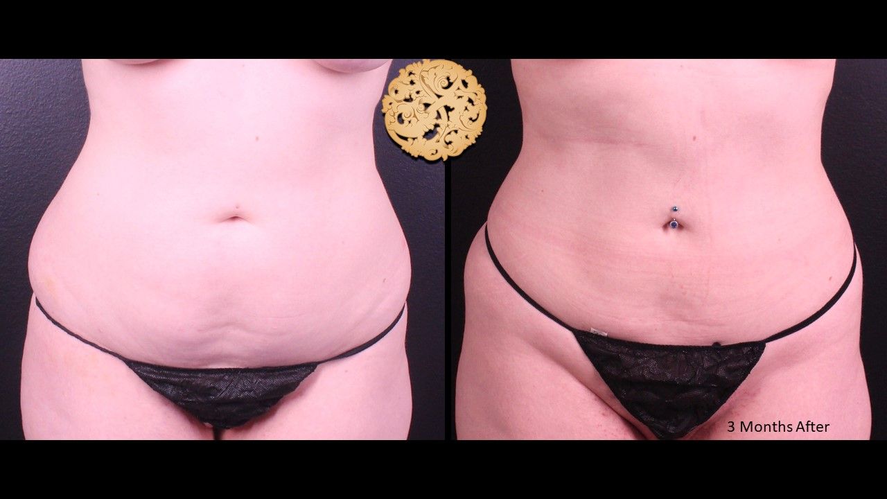 Liposuction Trunk Before & After