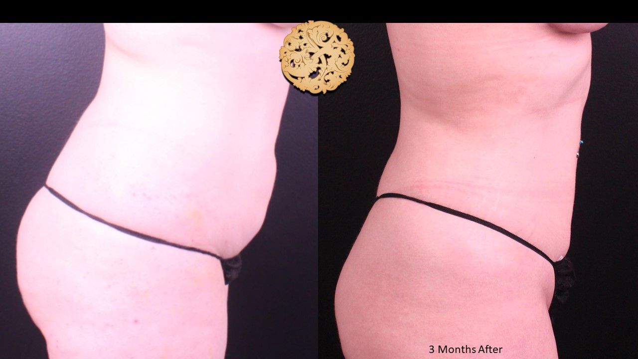 Liposuction Trunk Before & After