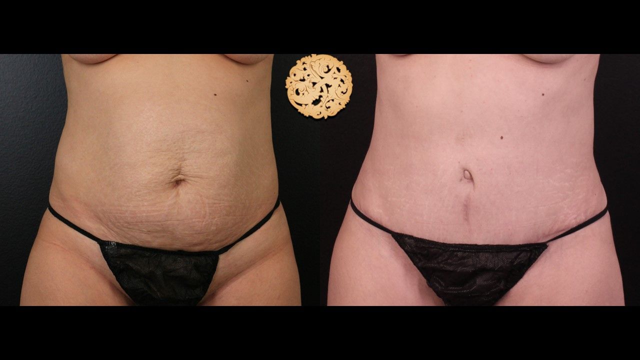 Liposuction Trunk Before & After