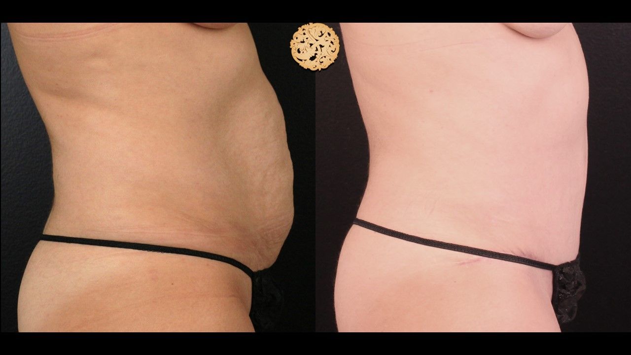 Liposuction Trunk Before & After