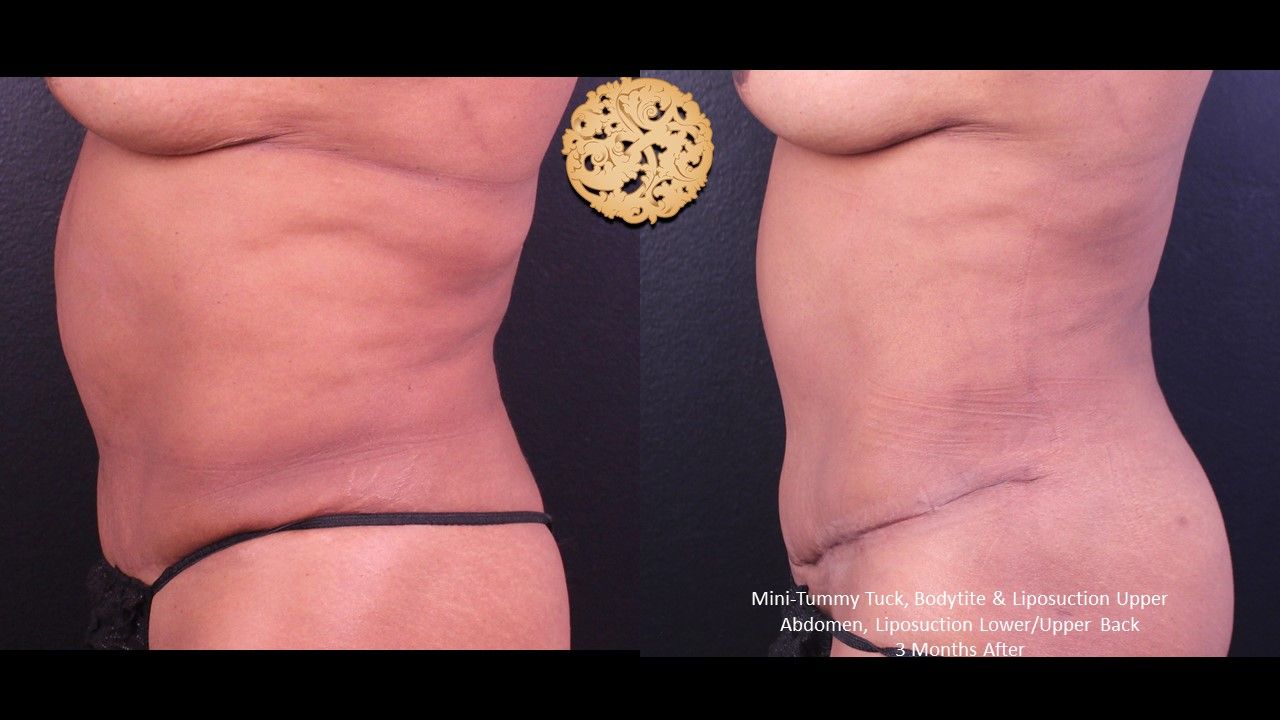 Liposuction Trunk Before & After