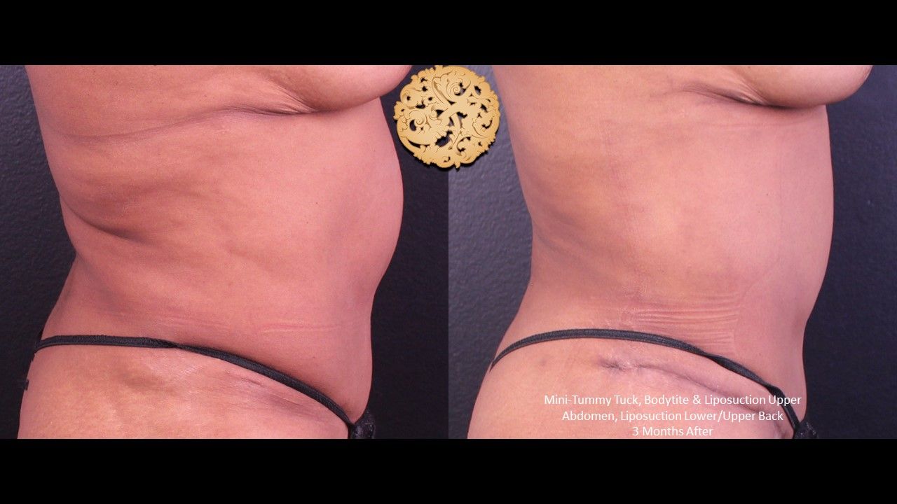 Liposuction Trunk Before & After
