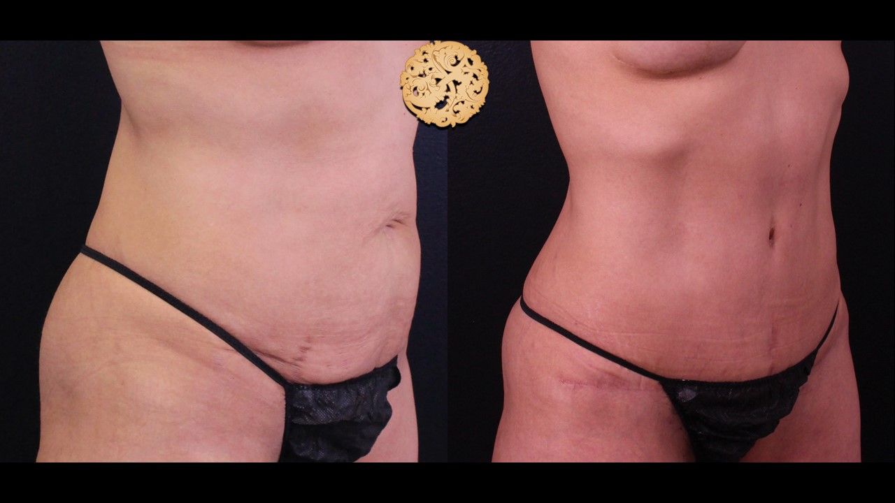 Liposuction Trunk Before & After