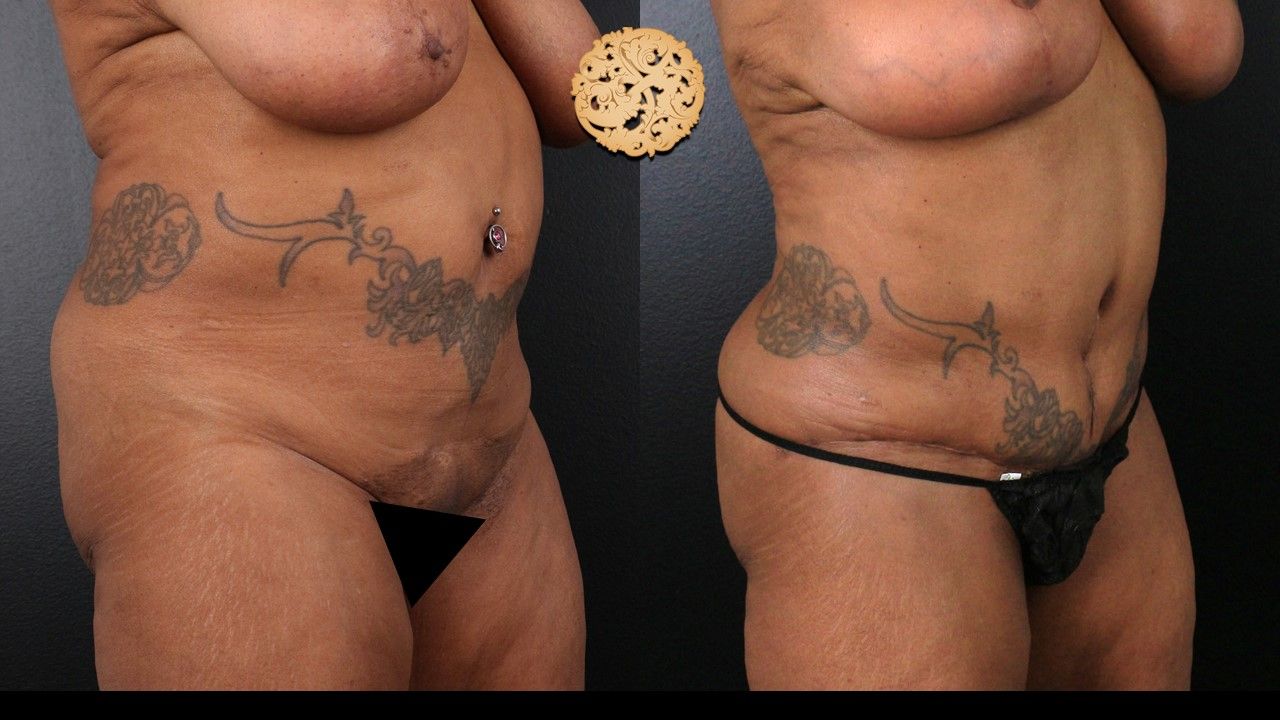 Liposuction Trunk Before & After