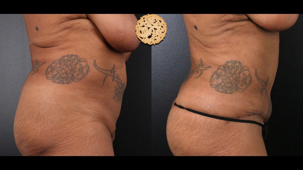 Liposuction Trunk Before & After