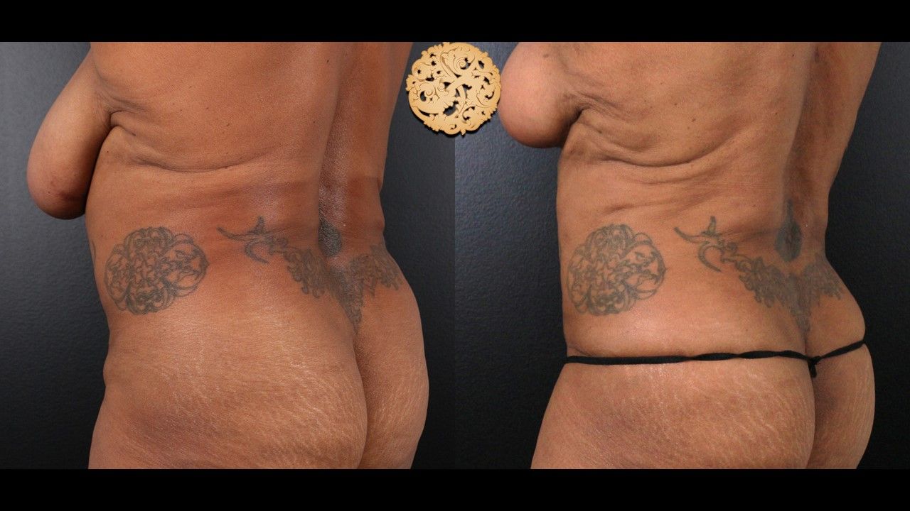 Liposuction Trunk Before & After