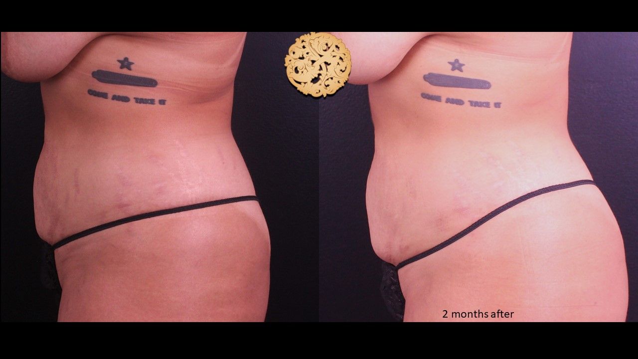 Liposuction Trunk Before & After