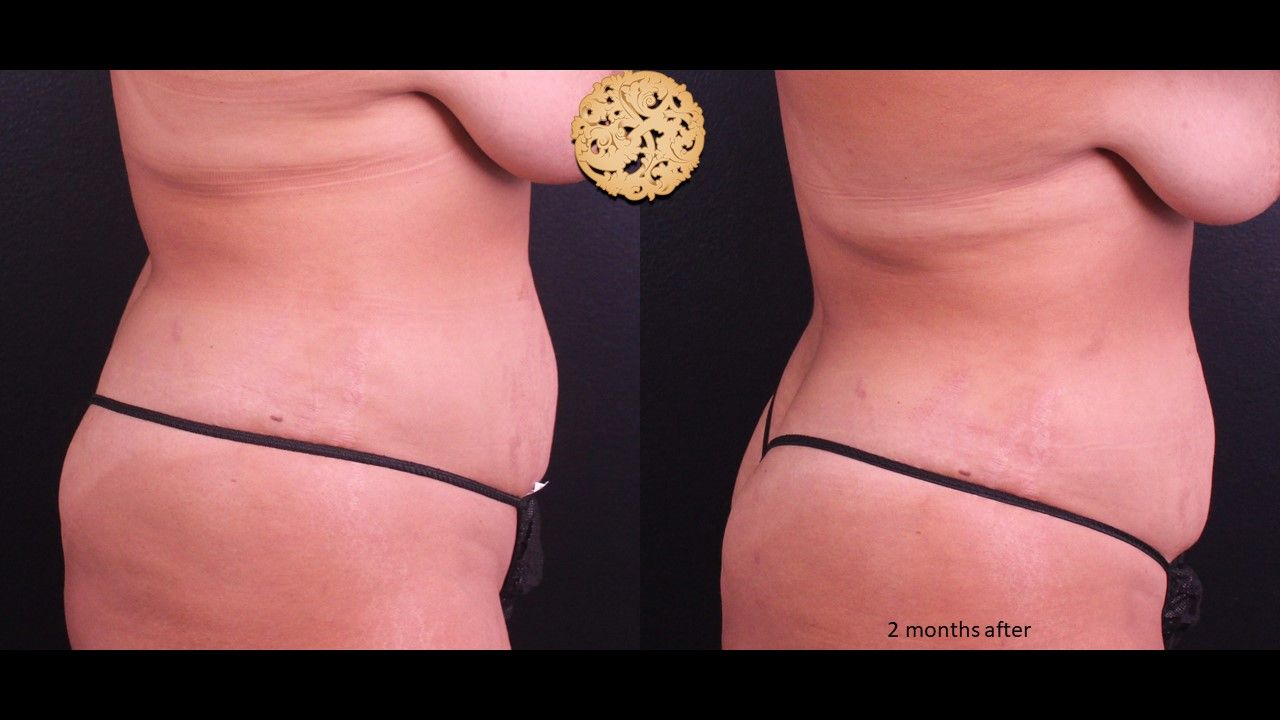 Liposuction Trunk Before & After