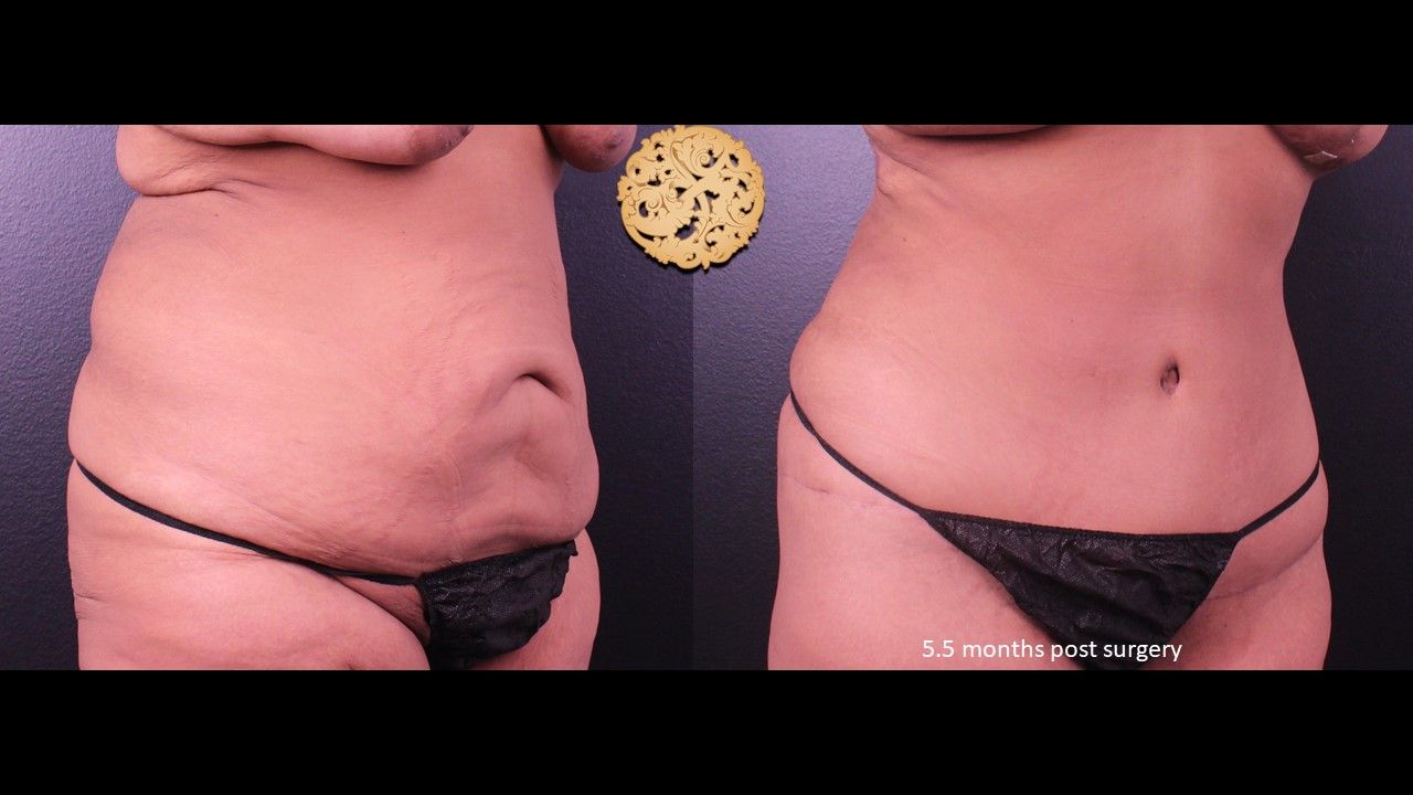 Liposuction Trunk Before & After