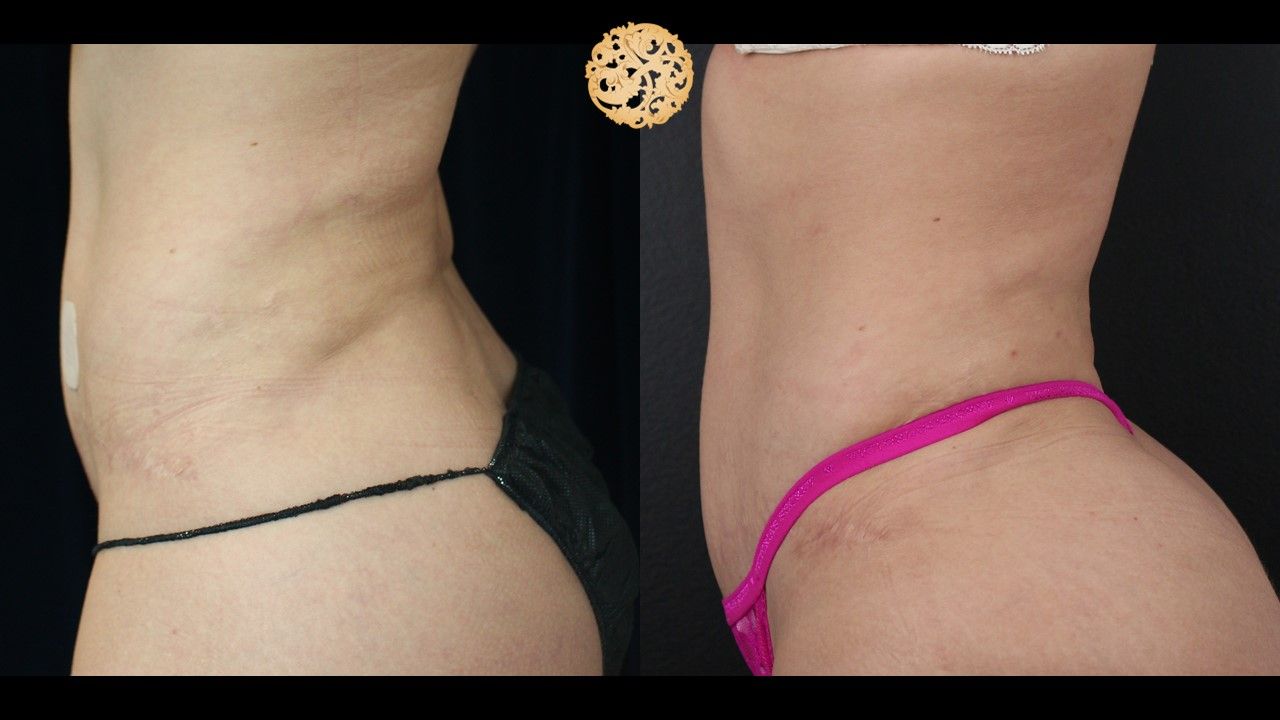 Liposuction Trunk Before & After