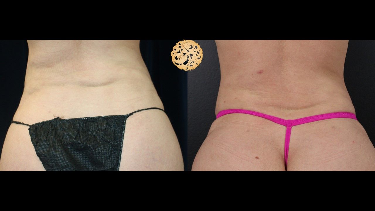 Liposuction Trunk Before & After
