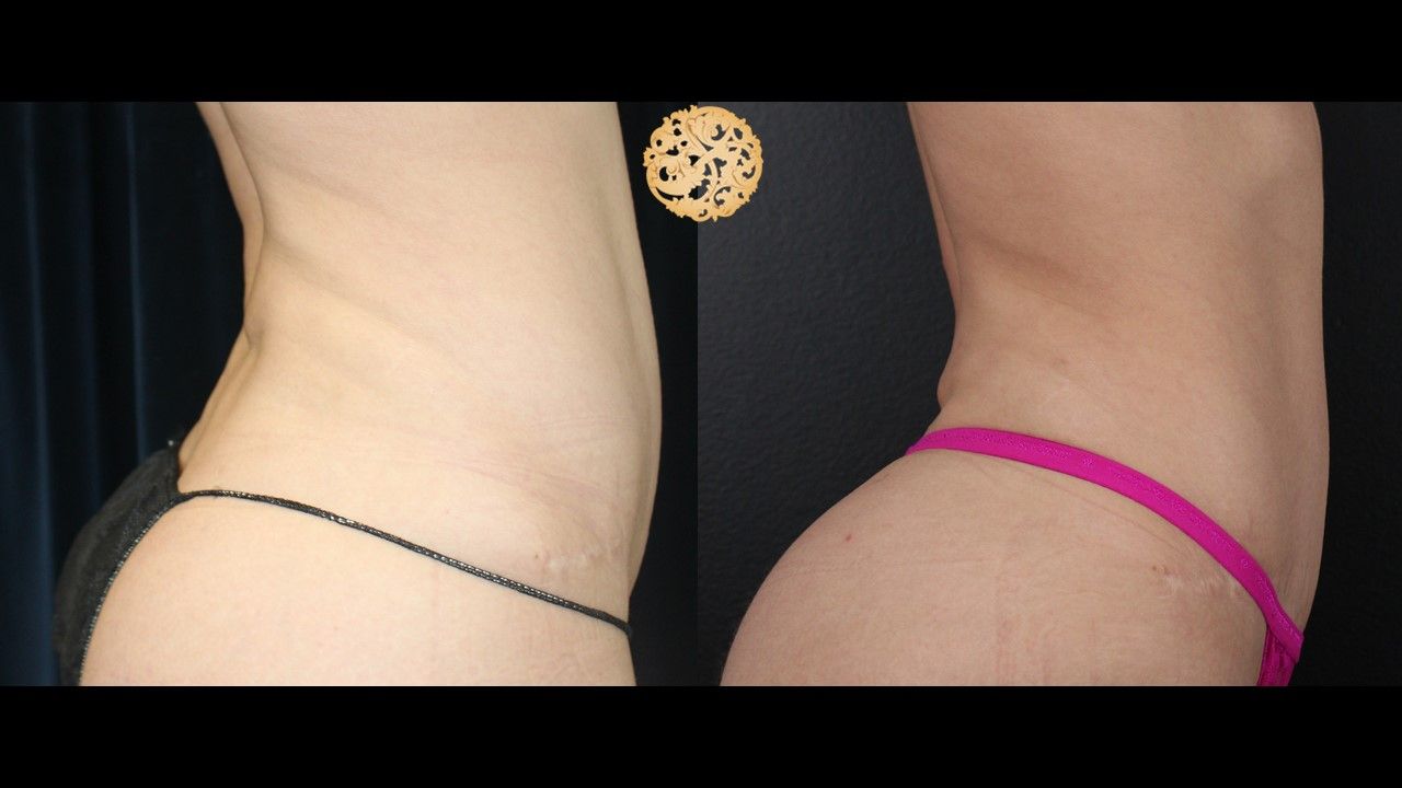 Liposuction Trunk Before & After