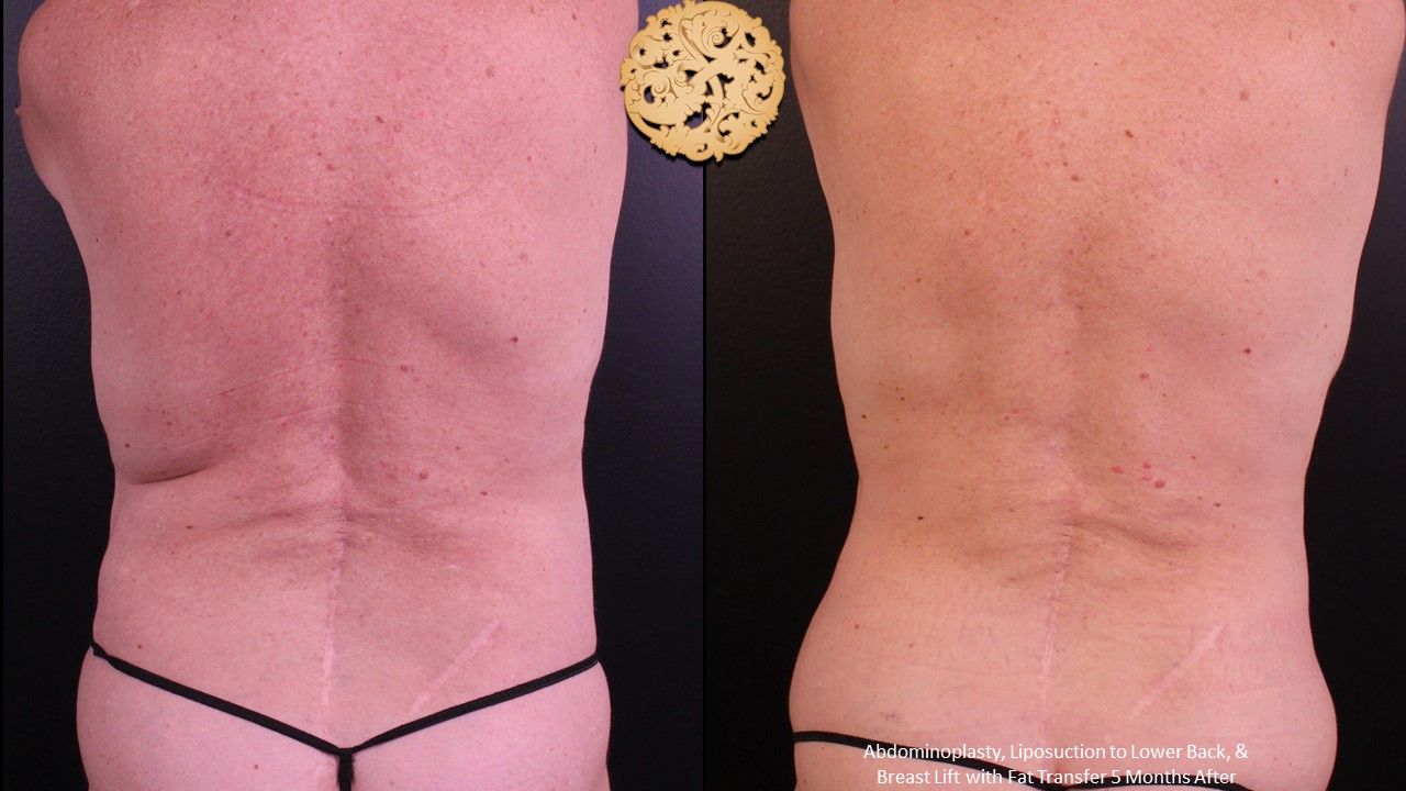 Liposuction Trunk Before & After
