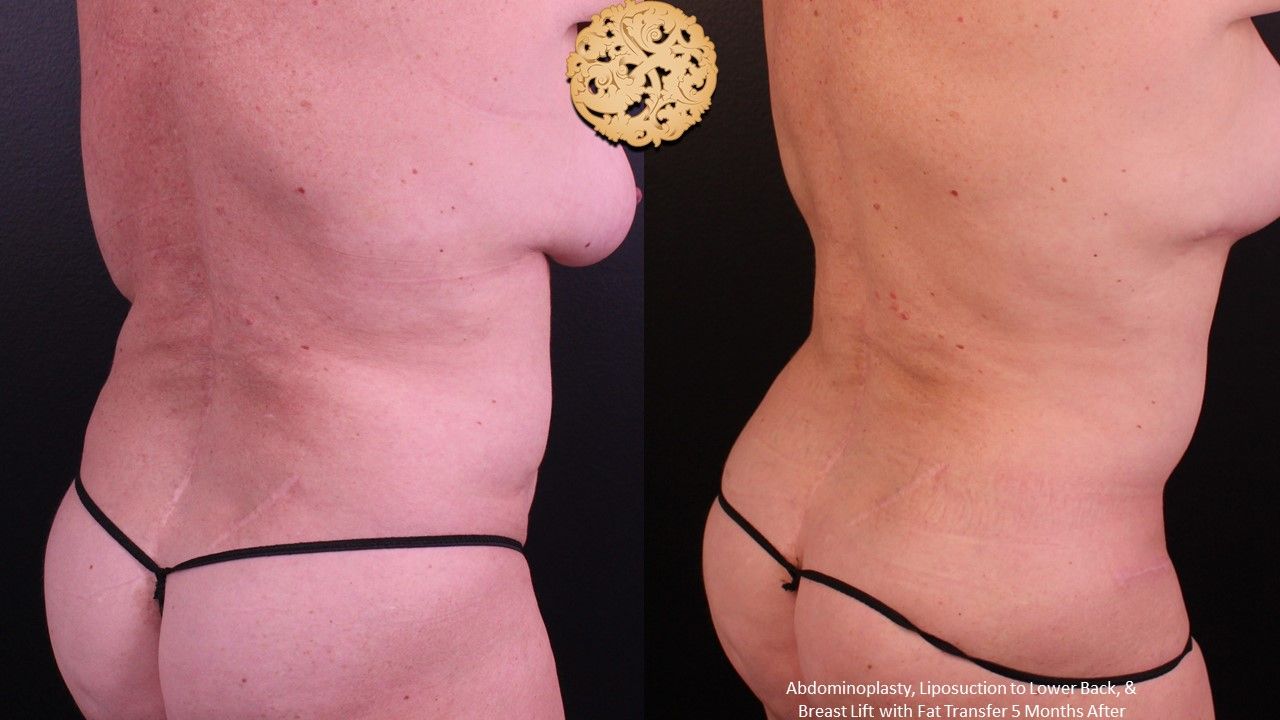 Liposuction Trunk Before & After