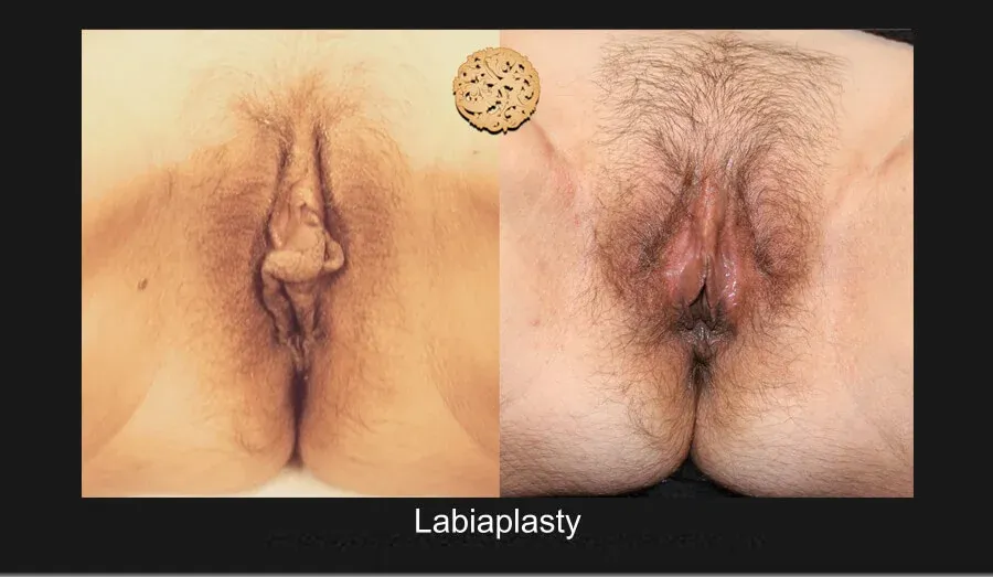 Vaginal Rejuvenation Before & After