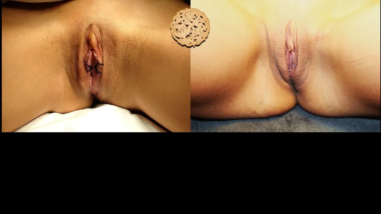 Vaginal Rejuvenation Before & After