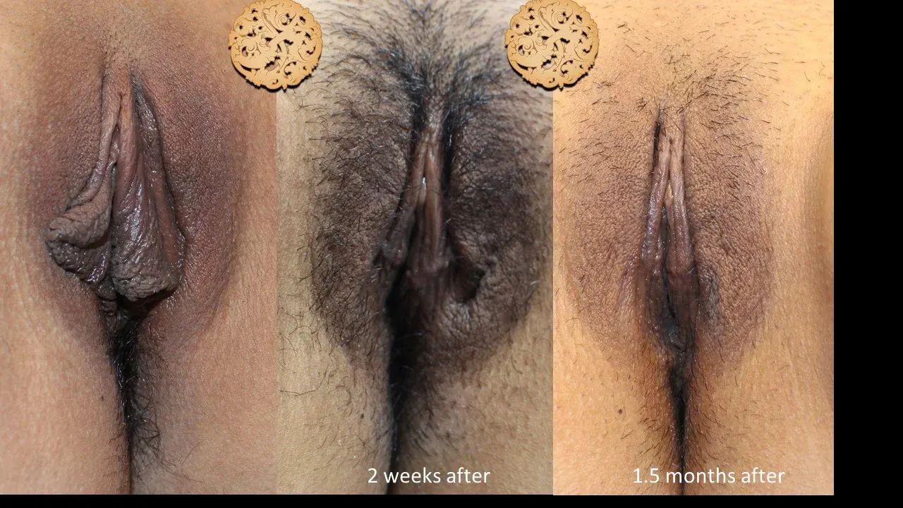 Vaginal Rejuvenation Before & After