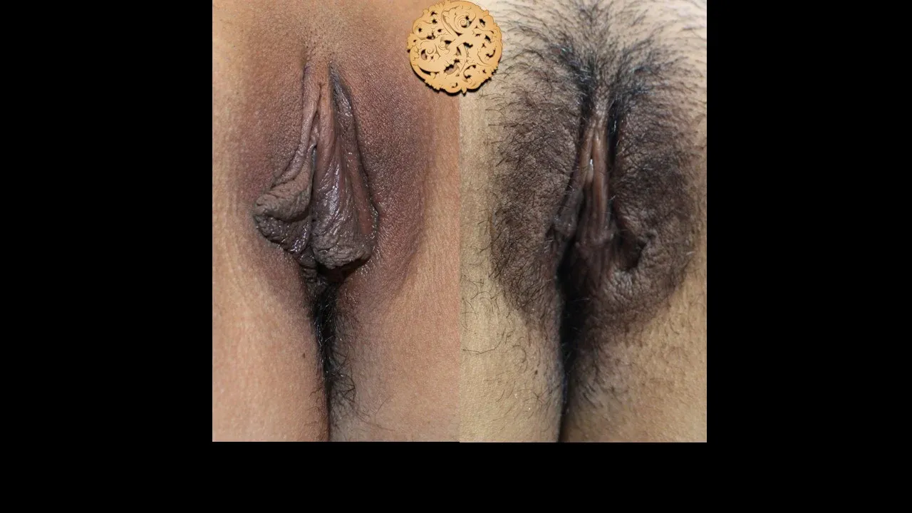 Vaginal Rejuvenation Before & After