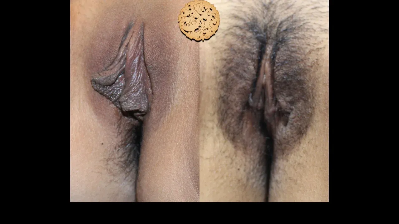 Vaginal Rejuvenation Before & After