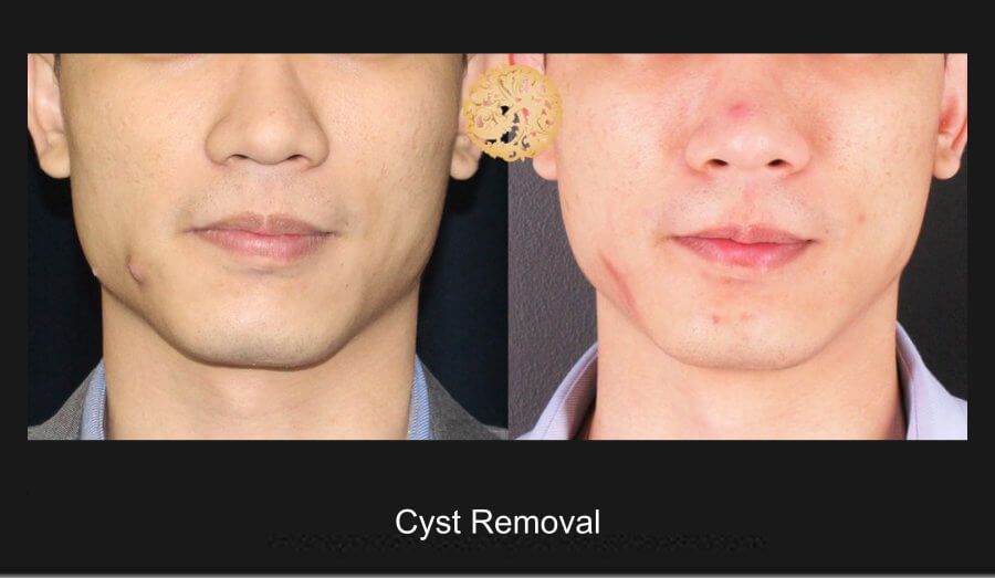 Cyst Removal Before & After