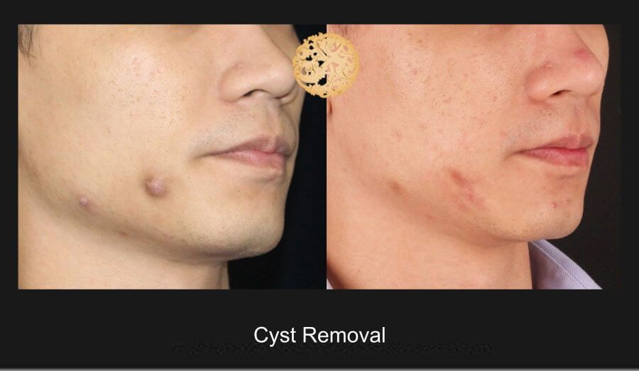 Cyst Removal Before & After