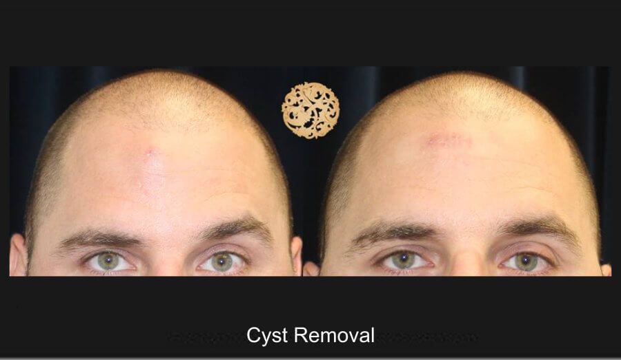 Cyst Removal Before & After