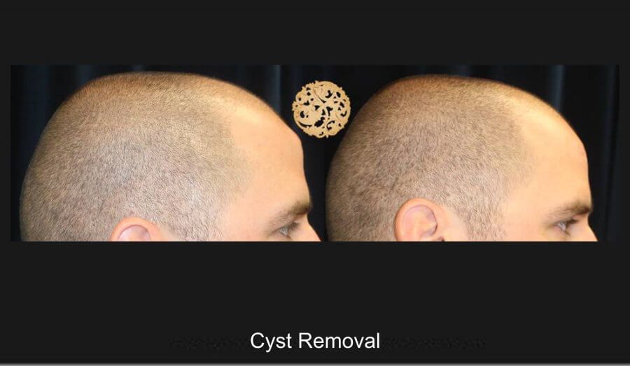 Cyst Removal Before & After