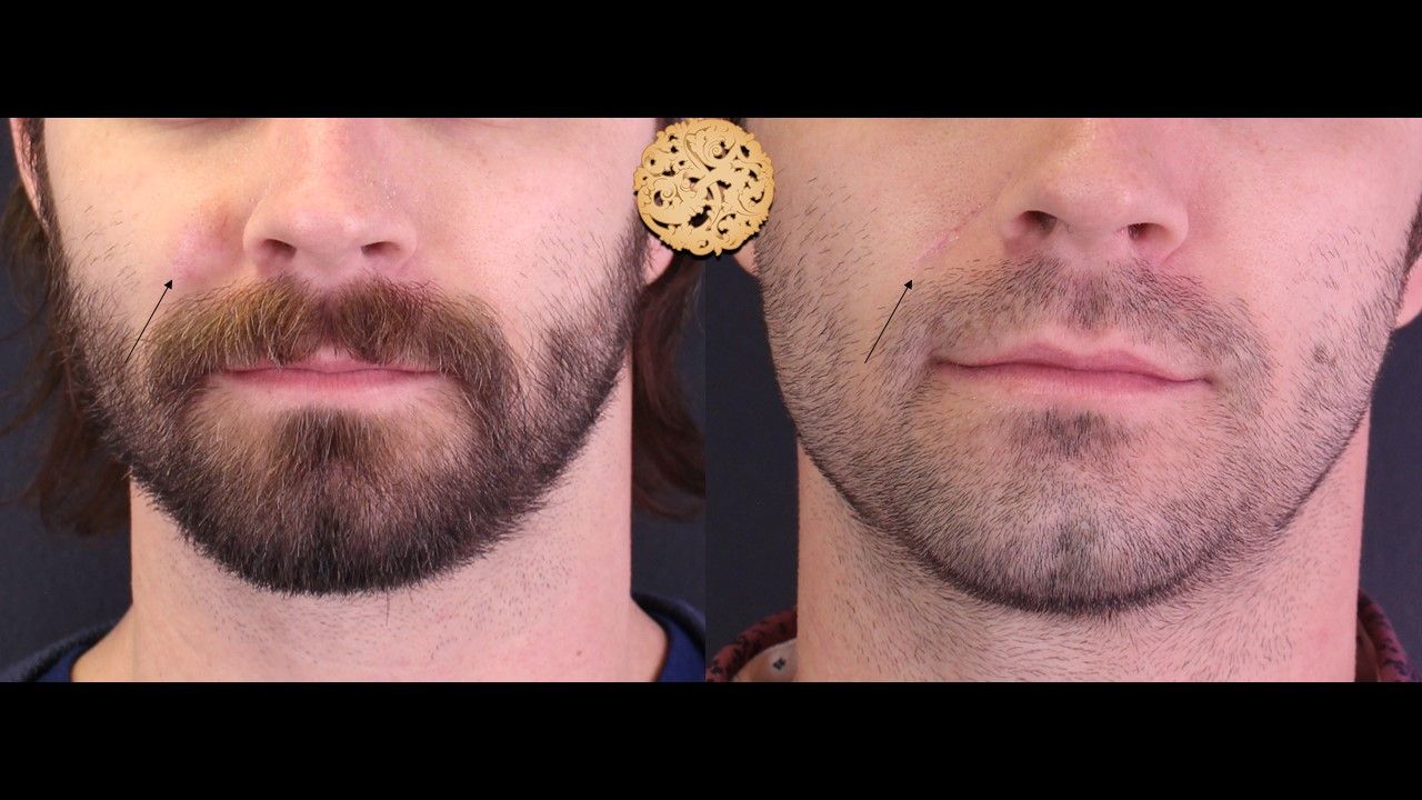 Cyst Removal Before & After