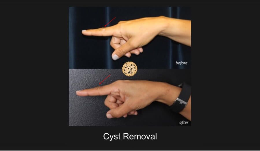 Cyst Removal Before & After