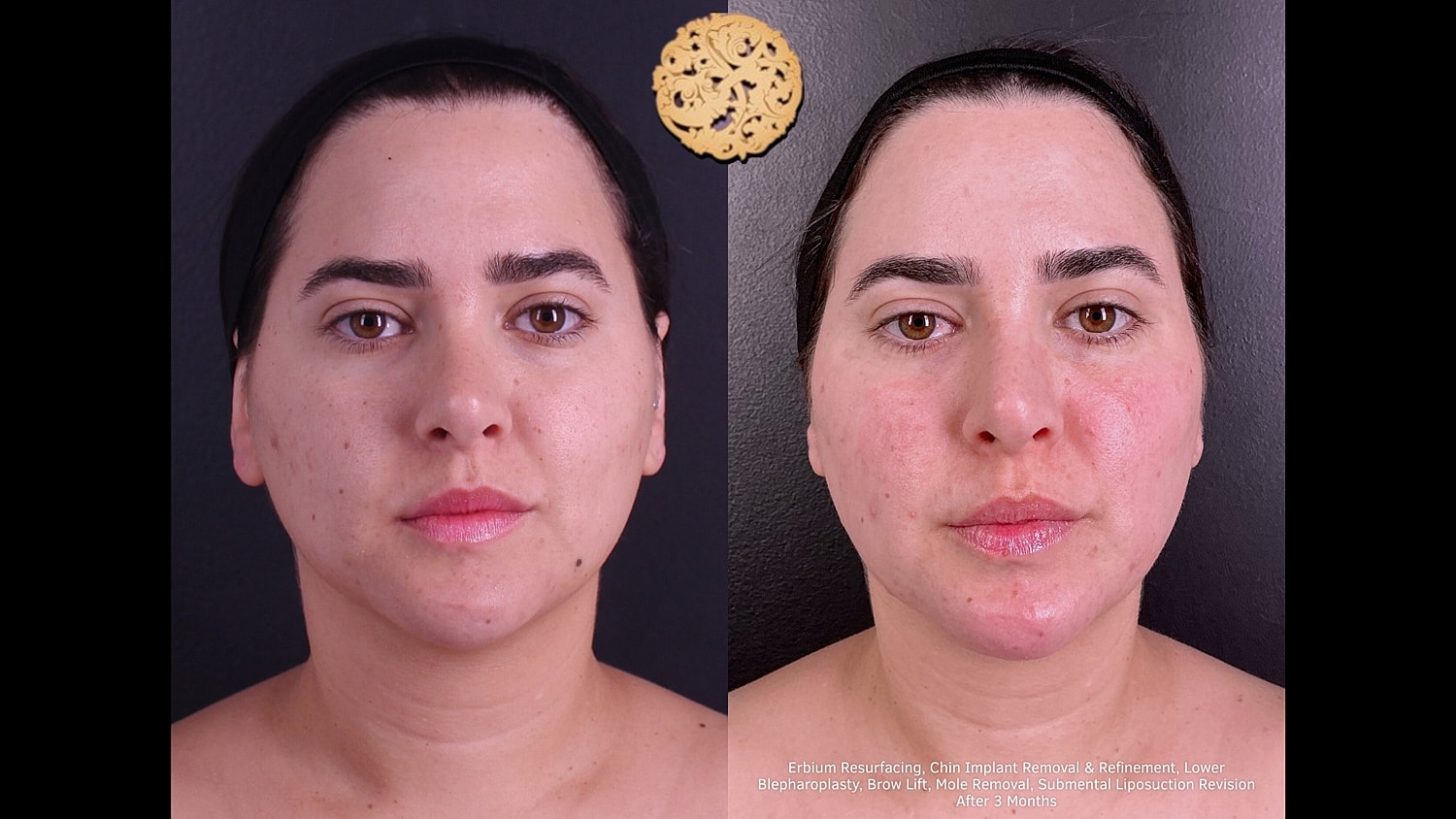 Erbium Resurfacing, Chin-Implant Removal/ Refinement, Lower Blepharoplasty, BrowLift, Mole Removal, Submental Liposuction Revision 3 months 