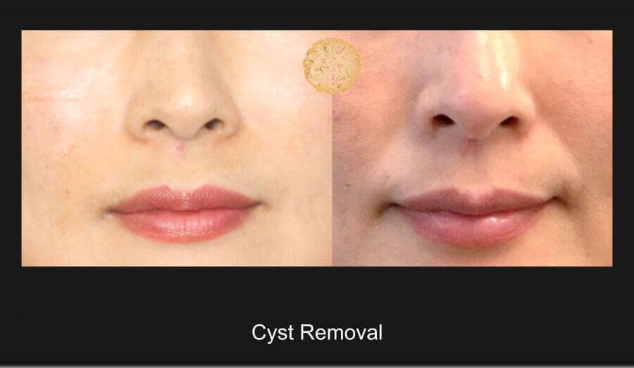 Cyst Removal Before & After