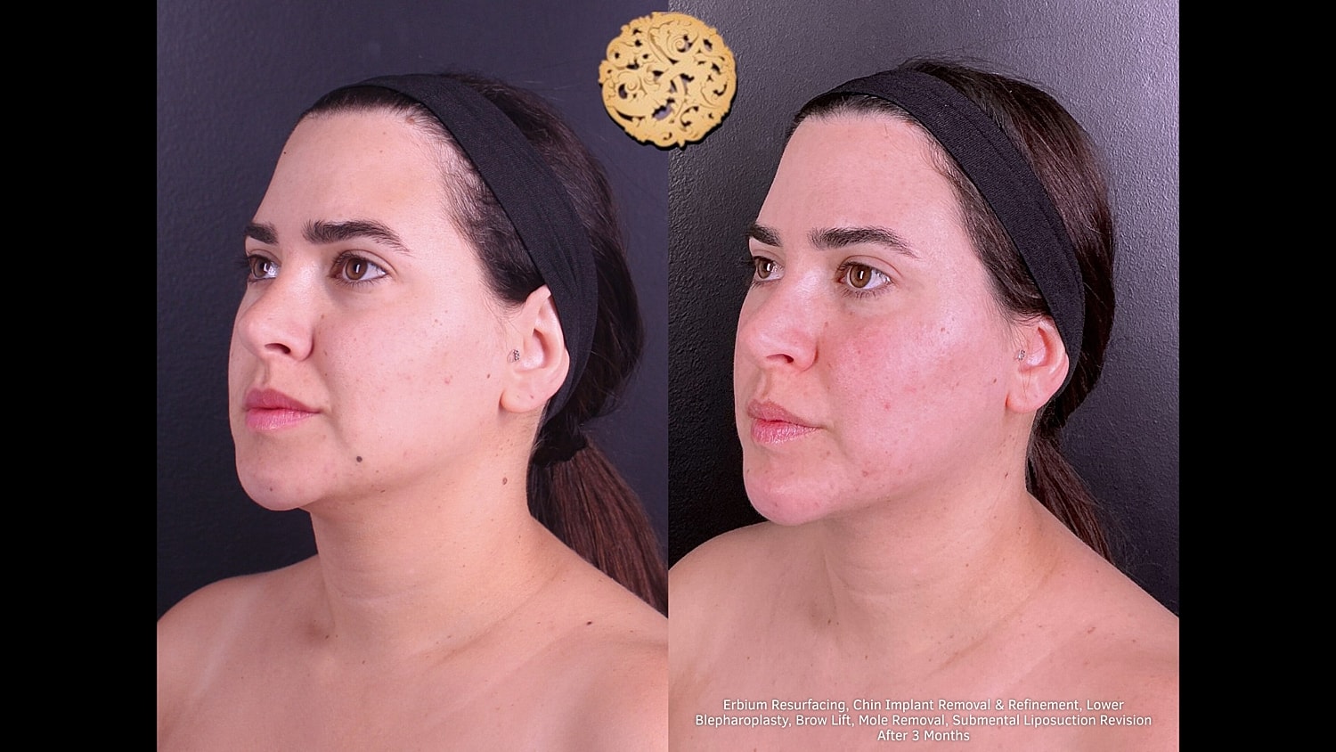 Erbium Resurfacing, Chin-Implant Removal/ Refinement, Lower Blepharoplasty, BrowLift, Mole Removal, Submental Liposuction Revision 3 months 