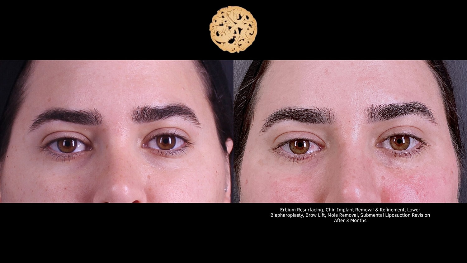 Erbium Resurfacing, Chin-Implant Removal/ Refinement, Lower Blepharoplasty, BrowLift, Mole Removal, Submental Liposuction Revision 3 months 