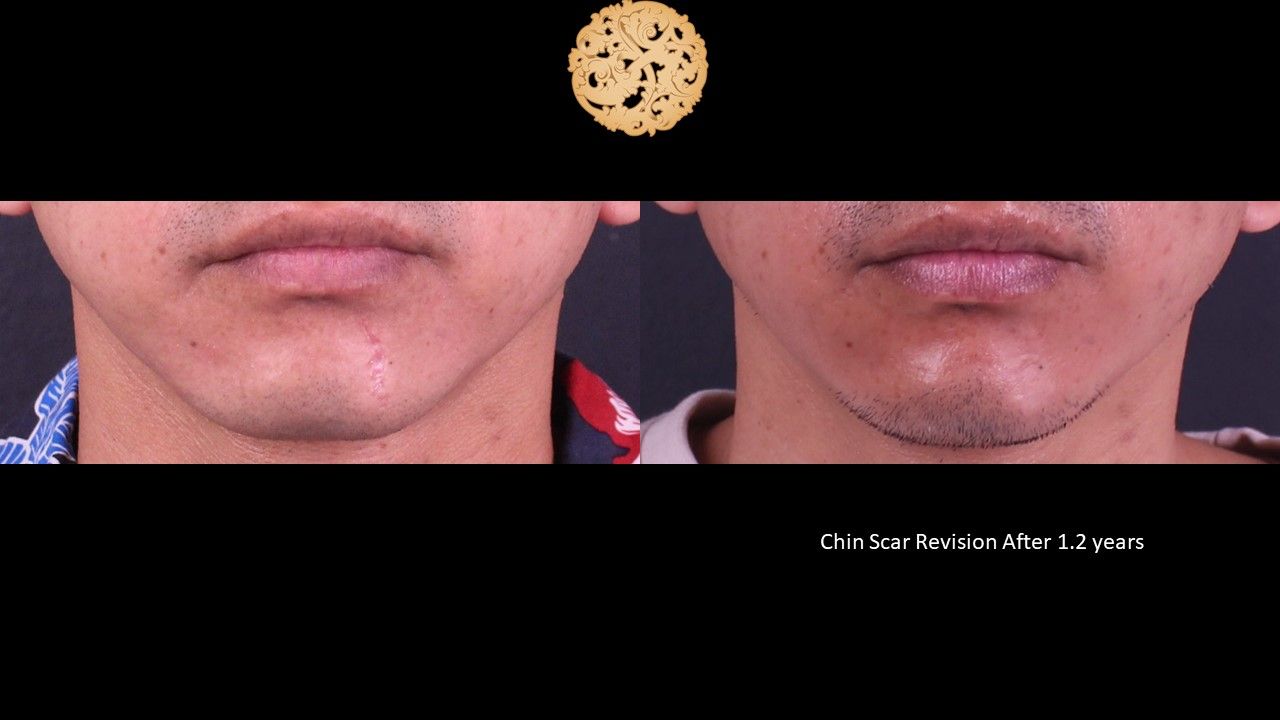 Scar Revision Before & After