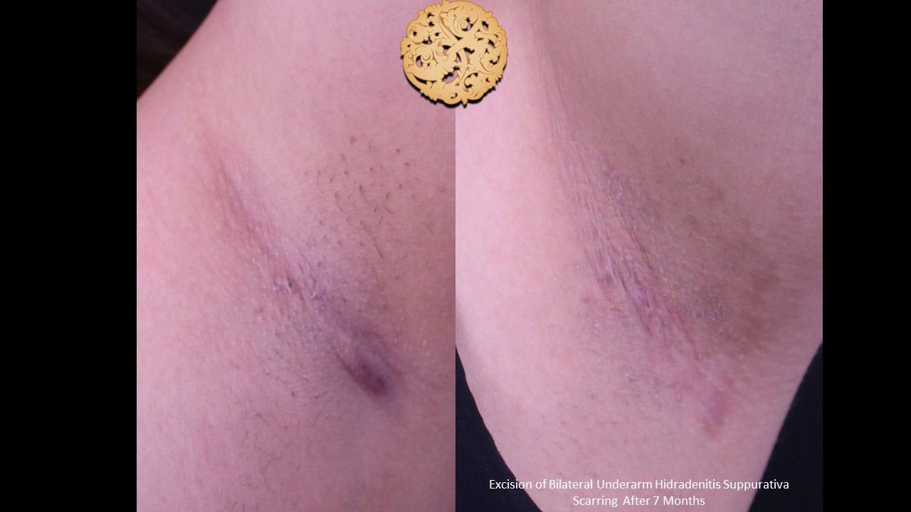 Scar Revision Before & After