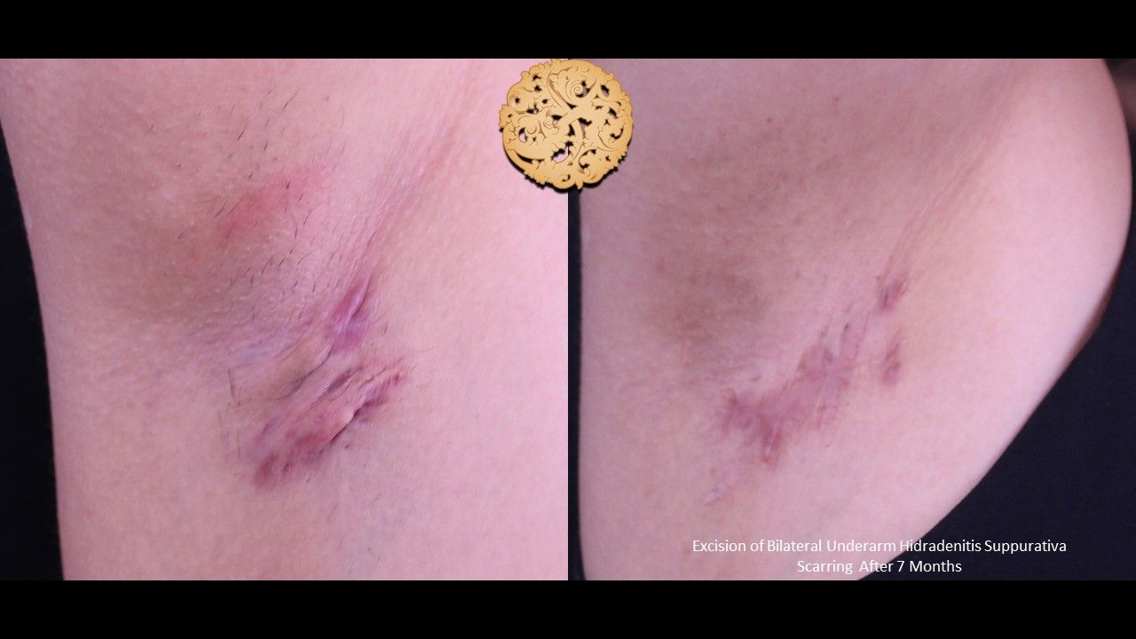 Scar Revision Before & After