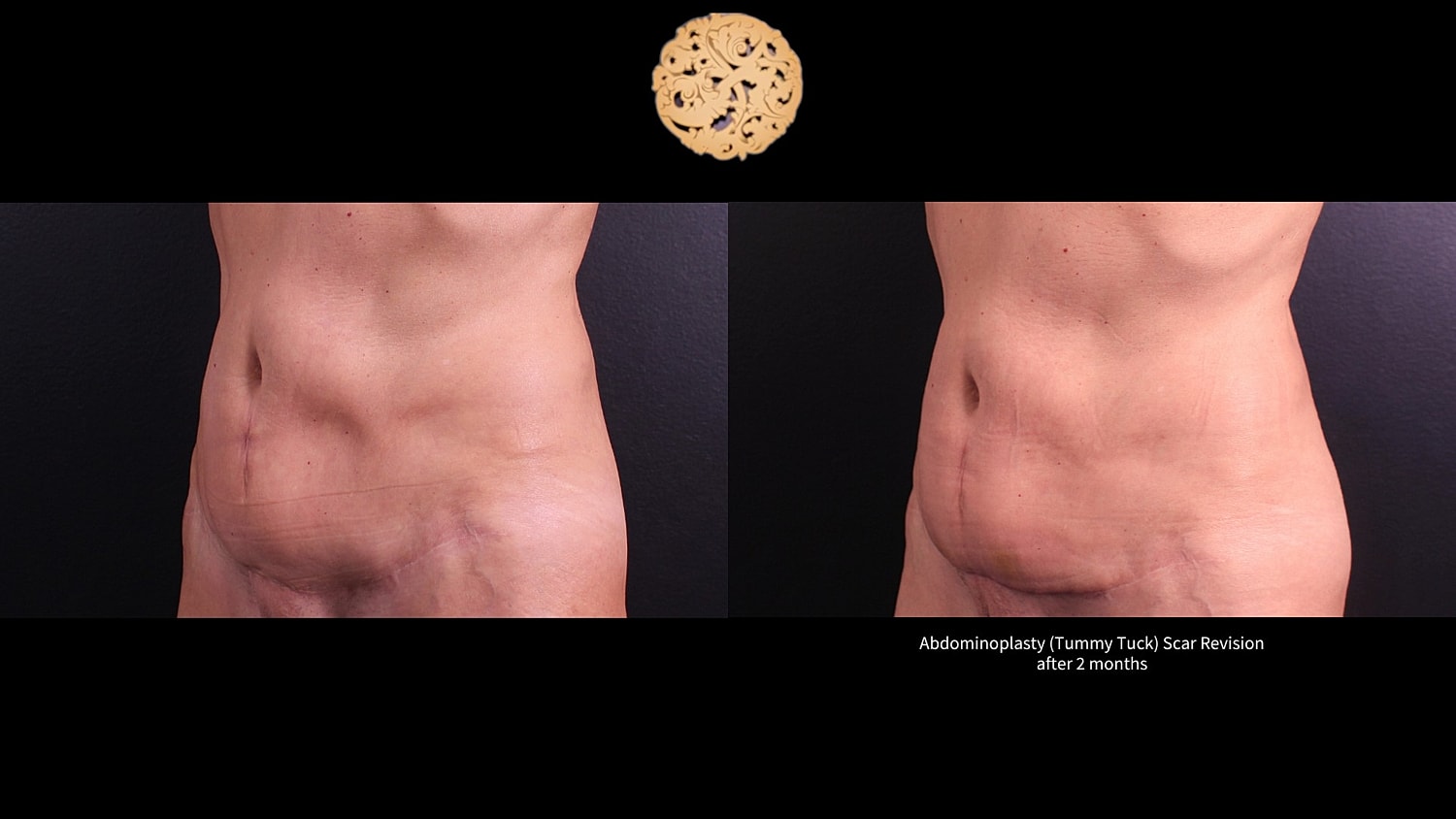 Scar Revision Before & After