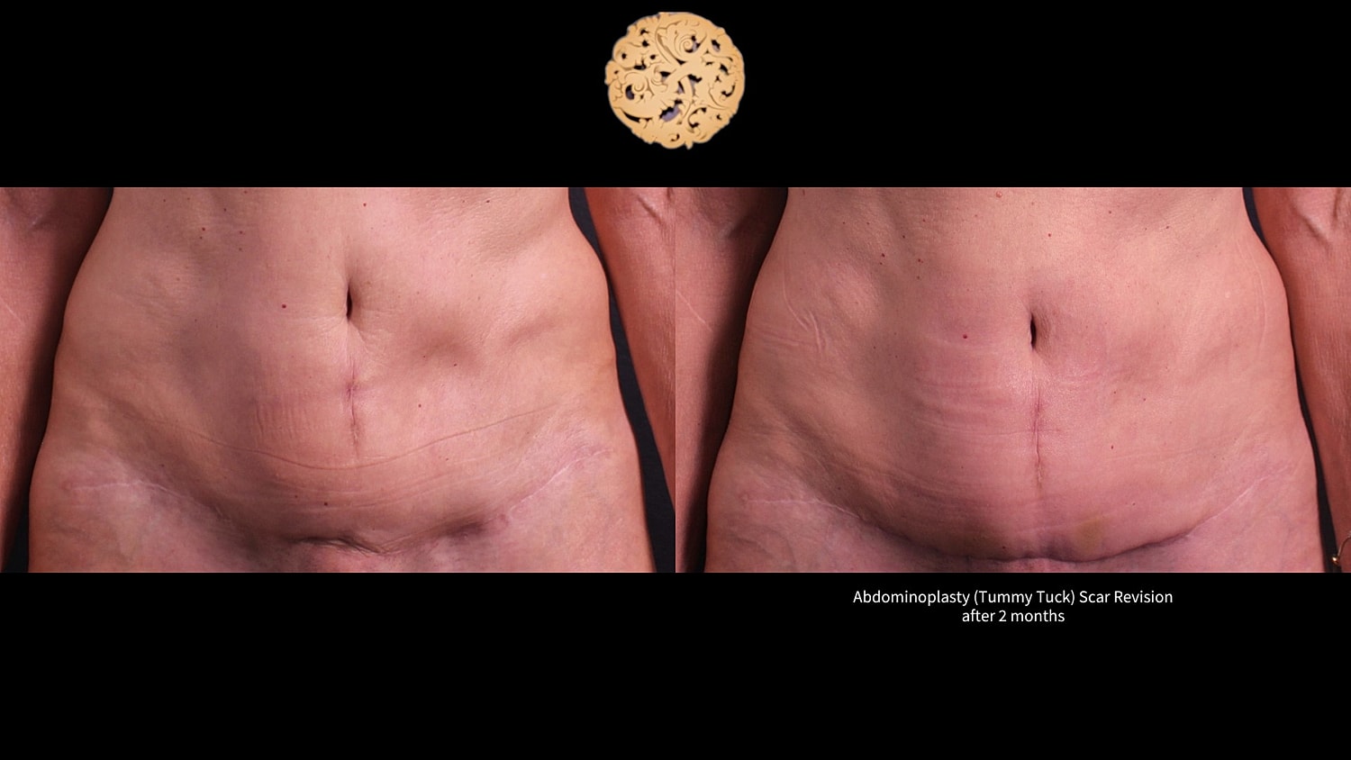 Scar Revision Before & After