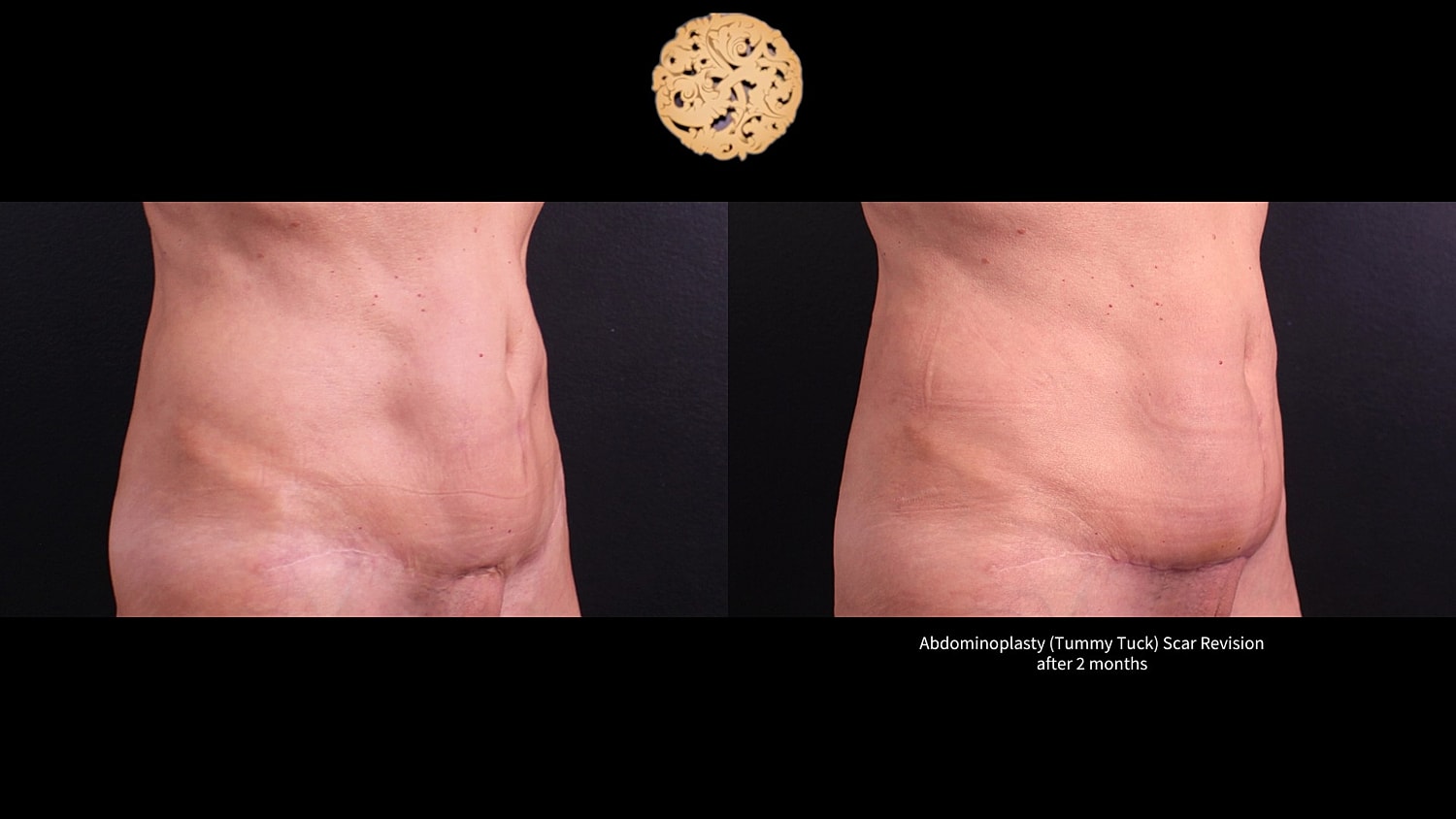 Scar Revision Before & After