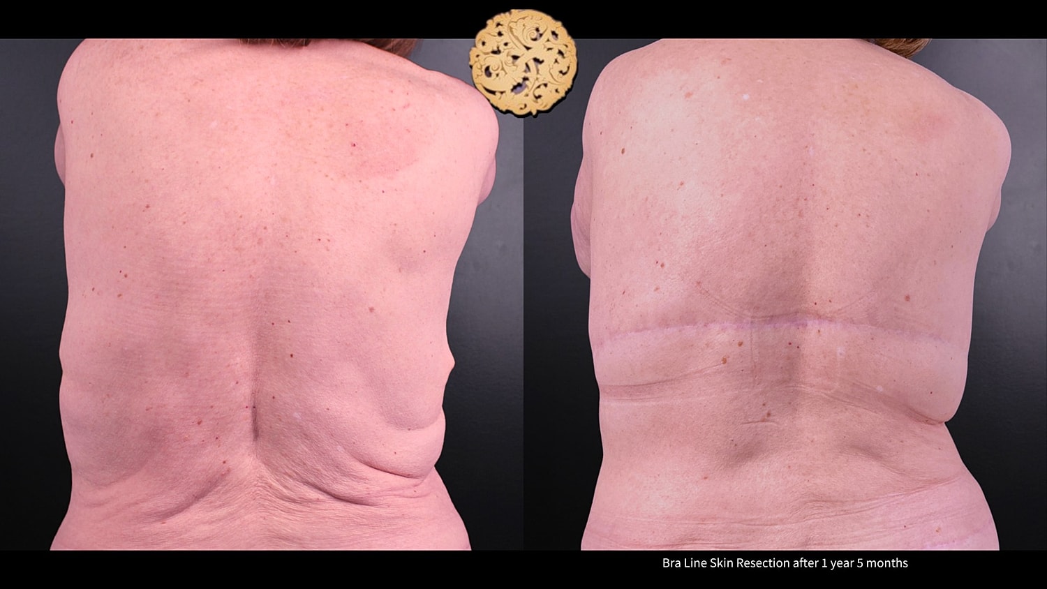 Scar Revision Before & After