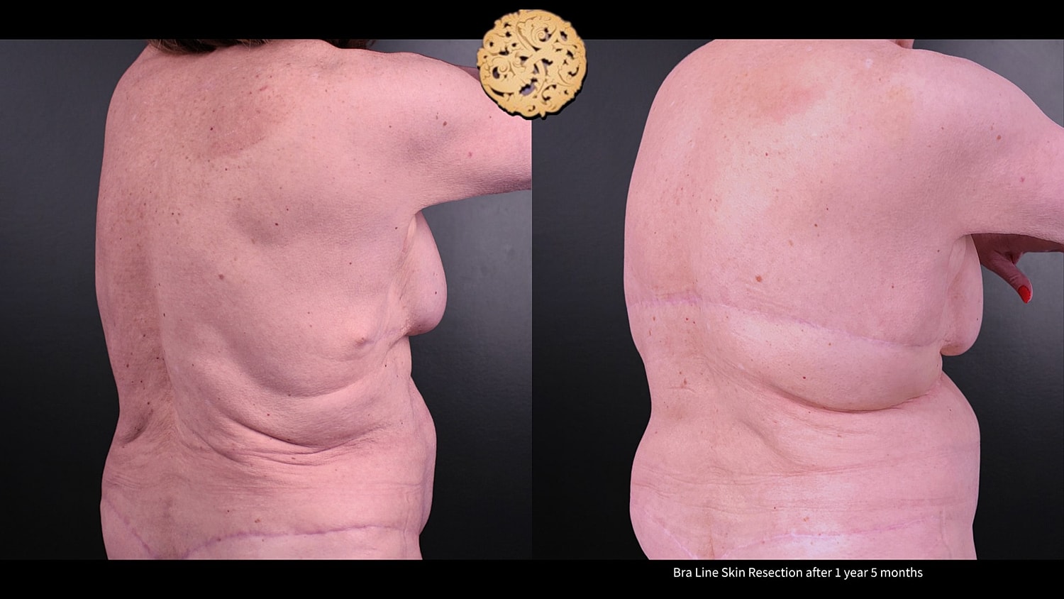 Scar Revision Before & After