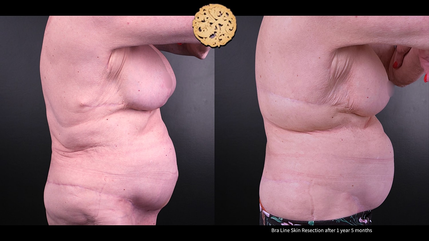 Scar Revision Before & After