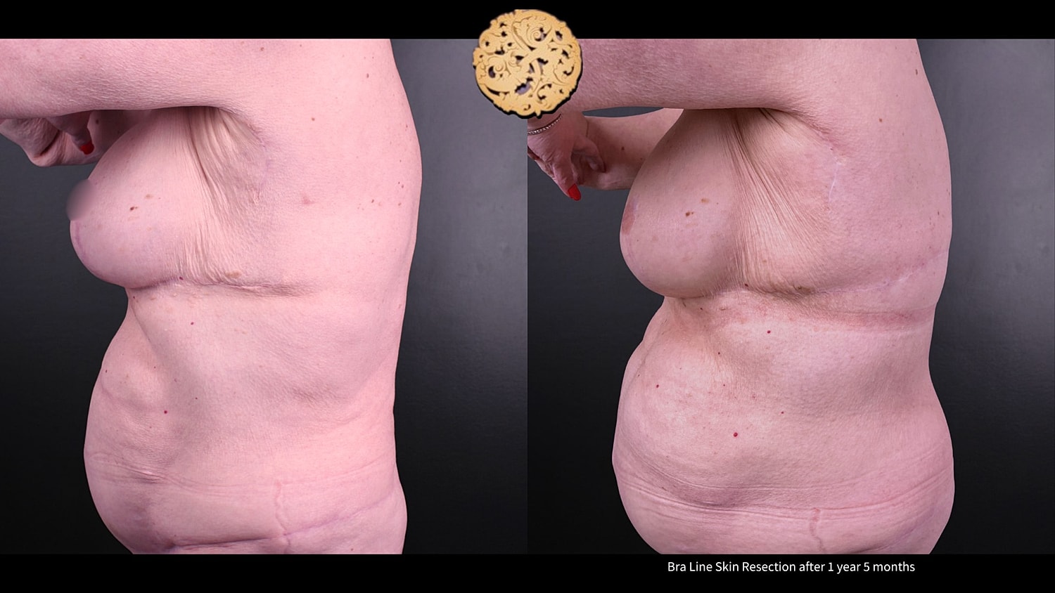 Scar Revision Before & After