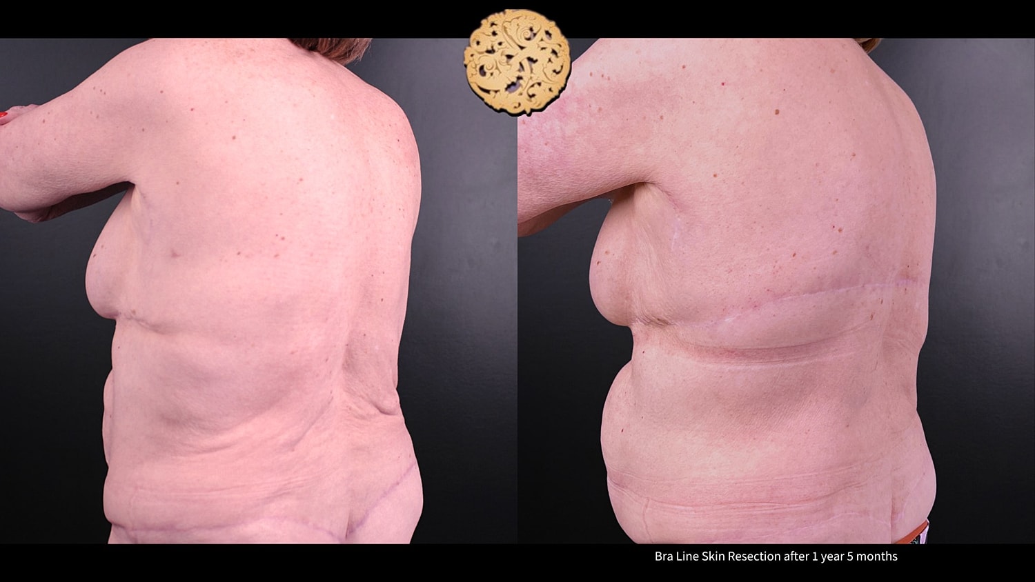 Scar Revision Before & After