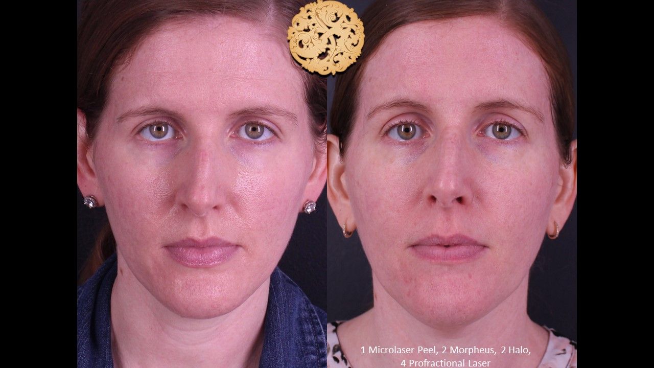 Profractional Before & After
