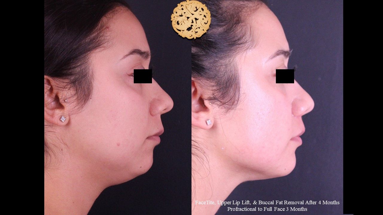 Profractional Before & After